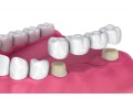dental-lab-crowns-and-bridge-small-0