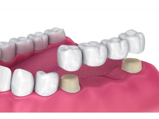 Dental Lab Crowns And Bridge